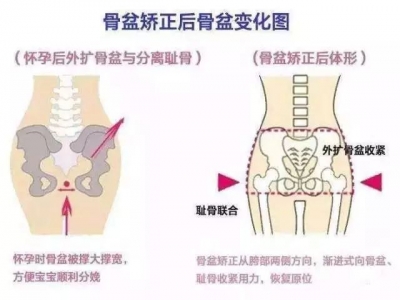 骨盆修復(fù) 真相大揭秘…… 做不做看完再?zèng)Q定!